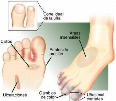 El hongo entre los dedos de los pies el tratamiento por el ácido bórico