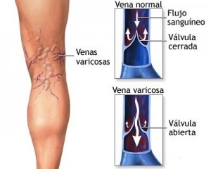 Eliminar las varices en los hombres